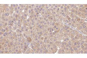 ABIN6273654 at 1/100 staining Human Melanoma tissue by IHC-P. (IL36A/IL1F6 抗体  (Internal Region))
