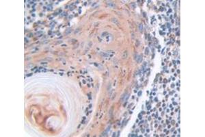 IHC-P analysis of Human Tissue, with DAB staining. (KRT6A 抗体  (AA 163-468))