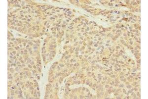 Immunohistochemistry of paraffin-embedded human ovarian cancer using ABIN7159905 at dilution of 1:100 (TIMM23 抗体  (AA 1-209))