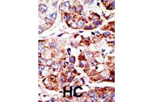 Formalin-fixed and paraffin-embedded human hepatocellular carcinoma tissue reacted with PIAS2 polyclonal antibody , which was peroxidase-conjugated to the secondary antibody, followed by DAB staining. (PIAS2 抗体  (C-Term))