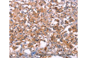 Immunohistochemistry of Human thyroid cancer using LILRB1 Polyclonal Antibody at dilution of 1:30 (LILRB1 抗体)