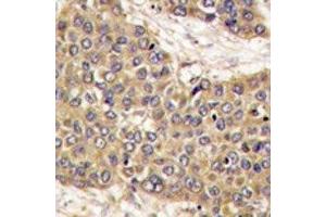 IHC analysis of FFPE human hepatocarcinoma tissue stained with Caspase-6 antibody (Caspase 6 抗体  (AA 235-263))