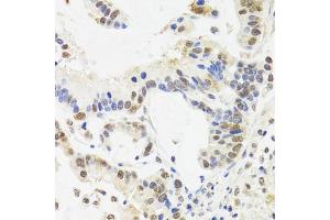 Immunohistochemistry of paraffin-embedded human gastric cancer using SUZ12 antibody (ABIN5975314) at dilution of 1/100 (40x lens). (SUZ12 抗体)