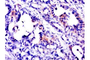 Paraformaldehyde-fixed, paraffin embedded human stomach cancer, Antigen retrieval by boiling in sodium citrate buffer (pH6. (PSCA 抗体  (AA 24-123))