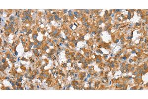 Immunohistochemistry of paraffin-embedded Human thyroid cancer tissue using CSMD1 Polyclonal Antibody at dilution 1:40 (CSMD1 抗体)