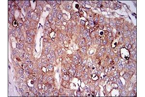 Immunohistochemical analysis of paraffin-embedded esophageal cancer tissues using NT5E mouse mAb with DAB staining. (CD73 抗体  (AA 30-250))