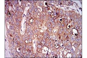 Immunohistochemical analysis of paraffin-embedded esophageal cancer tissues using NT5E mouse mAb with DAB staining.