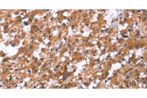 Immunohistochemistry of paraffin-embedded Human thyroid cancer using HSD17B1 Polyclonal Antibody at dilution of 1:40 (HSD17B1 抗体)