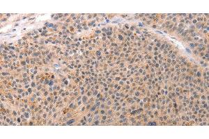 Immunohistochemistry of paraffin-embedded Human esophagus cancer tissue using ACIN1 Polyclonal Antibody at dilution 1:80 (ACIN1 抗体)