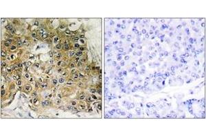 Immunohistochemistry analysis of paraffin-embedded human breast carcinoma, using Integrin beta1 (Phospho-Thr789) Antibody. (ITGB1 抗体  (pThr789))