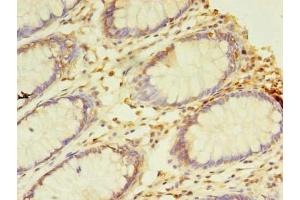 Immunohistochemistry of paraffin-embedded human colon cancer using ABIN7161747 at dilution of 1:100 (NAIF1 抗体  (AA 1-172))