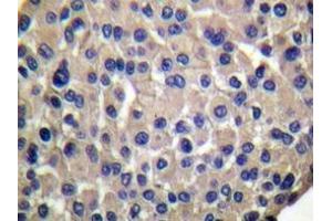 Immunohistochemistry analyzes of Mucin 1 antibody in paraffin-embedded human breast carcinoma. (MUC1 抗体)