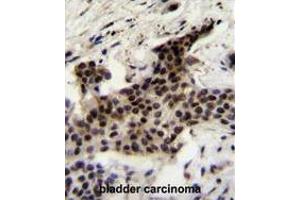 UBXN2A Antibody (C-term) immunohistochemistry analysis in formalin fixed and paraffin embedded human bladder carcinoma followed by peroxidase conjugation of the secondary antibody and DAB staining. (UBXN2A 抗体  (C-Term))