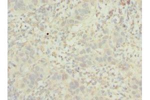 Immunohistochemistry of paraffin-embedded human bladder cancer using ABIN7163723 at dilution of 1:100 (POC1B 抗体  (AA 299-478))