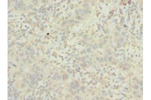Immunohistochemistry of paraffin-embedded human bladder cancer using ABIN7163723 at dilution of 1:100