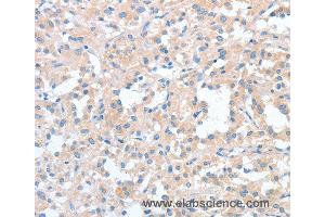 Immunohistochemistry of Human thyroid cancer using WNT3A Polyclonal Antibody at dilution of 1:40 (WNT3A 抗体)