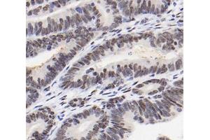Immunohistochemistry analysis of paraffin-embedded human colon cancer using RBM14 (ABIN7075474) at dilution of 1: 2000