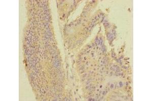 Immunohistochemistry of paraffin-embedded human colon cancer using ABIN7168416 at dilution of 1:100 (PDE6A 抗体  (AA 656-860))