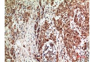 Immunohistochemistry (IHC) analysis of paraffin-embedded Human Breast Cancer, antibody was diluted at 1:100. (ZFPM2 抗体)