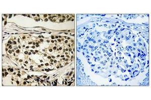 Immunohistochemical analysis of paraffin-embedded human breast carcinoma tissue using Cyclin C (Phospho-Ser275) antibody (left)or the same antibody preincubated with blocking peptide (right). (Cyclin C 抗体  (pSer275))