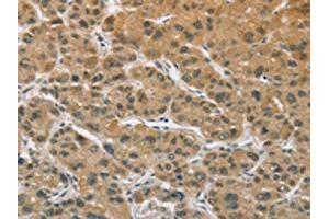 The image on the left is immunohistochemistry of paraffin-embedded Human liver cancer tissue using ABIN7129356(ELAC2 Antibody) at dilution 1/30, on the right is treated with fusion protein. (ELAC2 抗体)