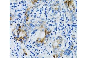 Immunohistochemistry of paraffin-embedded Human gastric cancer using MMP7 Polyclonal Antibody at dilution of 1:100 (40x lens). (MMP7 抗体)