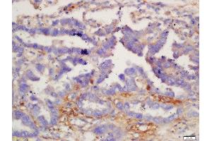 Formalin-fixed and paraffin embedded human lung carcinoma labeled with Anti-IL-12 beta Polyclonal Antibody, Unconjugated  at 1:200 followed by conjugation to the secondary antibody and DAB staining. (IL12B 抗体  (AA 201-300))