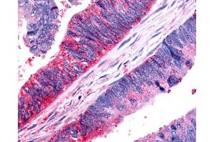 Anti-FZD7 / Frizzled 7 antibody IHC of human Colon, Carcinoma. (FZD7 抗体  (N-Term))