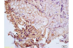 Formalin-fixed and paraffin embedded human colon carcinoma labeled with Anti-Phospho-PPAR Gamma (ser112) Polyclonal Antibody, Unconjugated (ABIN703405) at 1:200, followed by conjugation to the secondary antibody and DAB staining