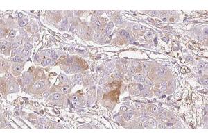 ABIN6272735 at 1/100 staining Human liver cancer tissue by IHC-P. (LPAR4 抗体  (C-Term))