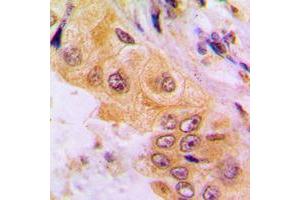 Immunohistochemical analysis of Cytochrome P450 2A7 staining in human liver cancer formalin fixed paraffin embedded tissue section. (CYP2A7 抗体  (C-Term))
