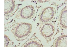 Immunohistochemistry of paraffin-embedded human colon cancer using ABIN7163613 at dilution of 1:100 (PLA2G7 抗体  (AA 49-441))
