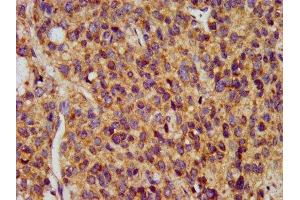 IHC image of ABIN7159750 diluted at 1:400 and staining in paraffin-embedded human glioma performed on a Leica BondTM system. (MAP1A 抗体  (AA 1979-2168))