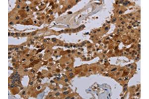 The image on the left is immunohistochemistry of paraffin-embedded Human prostate cancer tissue using ABIN7190333(COX18 Antibody) at dilution 1/20, on the right is treated with synthetic peptide. (COX18 抗体)