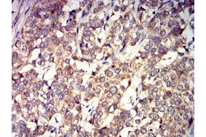 Immunohistochemical analysis of paraffin-embedded bladder cancer tissues using GRIK4 mouse mAb with DAB staining. (GRIK4 抗体  (AA 21-166))
