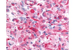 Anti-CHRM2 / M2 antibody IHC of human Brain, Glioblastoma. (Muscarinic Acetylcholine Receptor M2 抗体  (Cytoplasmic Domain))