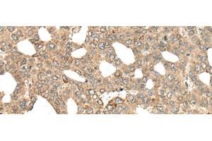 Immunohistochemistry of paraffin-embedded Human liver cancer tissue using APC Polyclonal Antibody at dilution of 1:45(x200)