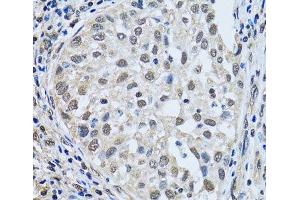 Immunohistochemistry of paraffin-embedded Human lung cancer using LSM4 Polyclonal Antibody at dilution of 1:100 (40x lens). (LSM4 抗体)