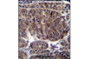 PREF3 Antibody (C-term) (ABIN656587 and ABIN2845849) immunohistochemistry analysis in formalin fixed and paraffin embedded human melanoma followed by peroxidase conjugation of the secondary antibody and DAB staining. (PRAMEF3 抗体  (C-Term))