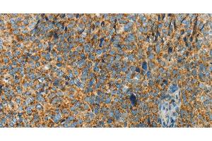 Immunohistochemistry of paraffin-embedded Human cervical cancer using BCAT2 Polyclonal Antibody at dilution of 1:70 (BCAT2 抗体)