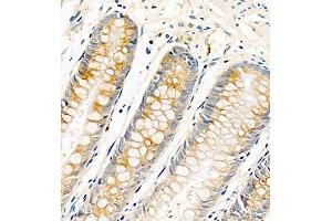 Immunohistochemistry of paraffin embedded human colon cancer using AnnexinA13 (ABIN7073061) at dilution of 1:1500 (400x lens) (Annexin A13 抗体)