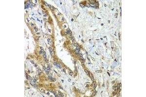 Immunohistochemistry of paraffin-embedded human liver cancer using CDC16 antibody (ABIN5974330) at dilution of 1/100 (40x lens). (CDC16 抗体)