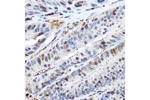 Immunohistochemistry of paraffin-embedded human colon carcinoma using CDK2 Rabbit pAb  at dilution of 1:200 (40x lens). (CDK2 抗体)