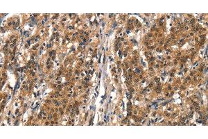 Immunohistochemistry of paraffin-embedded Human gastric cancer tissue using DDX4 Polyclonal Antibody at dilution 1:40 (DDX4 抗体)