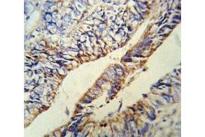 Anti-PCSK9 antibody IHC analysis in formalin fixed and paraffin embedded human colon carcinoma.