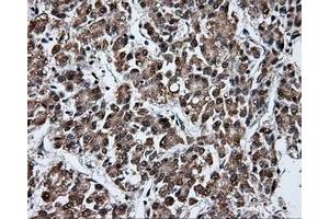 Immunohistochemical staining of paraffin-embedded Carcinoma of liver tissue using anti-FAHD2A mouse monoclonal antibody. (FAHD2A 抗体)