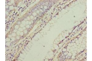 Immunohistochemistry of paraffin-embedded human colon cancer using ABIN7161338 at dilution of 1:100 (NMUR1 抗体  (AA 360-426))