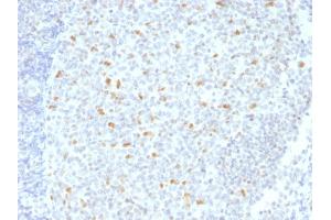 Formalin-fixed, paraffin-embedded human Hodgkin's Lymphoma stained with BCL-6 Mouse Monoclonal Antibody (BCL6/1526). (BCL6 抗体  (AA 256-389))
