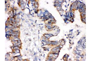 Anti- IGFBP3 Picoband antibody, IHC(P) IHC(P): Human Intestinal Cancer Tissue (IGFBP3 抗体  (C-Term))