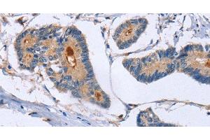 Immunohistochemistry of paraffin-embedded Human colon cancer using GMFG Polyclonal Antibody at dilution of 1:50 (GMFG 抗体)